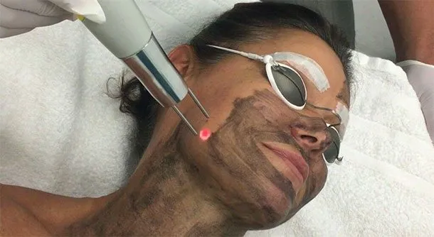 Is Laser Carbon Peel Good for Acne-Prone Skin