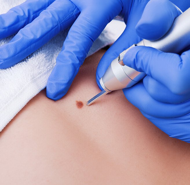Warts Removal Treatment Abu Dhabi
