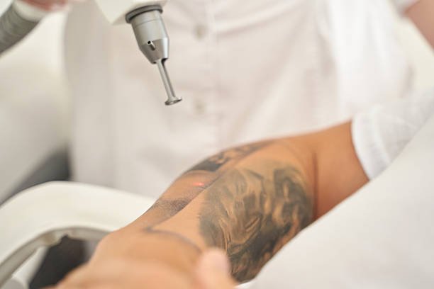Laser Tattoo Removal in Riyadh