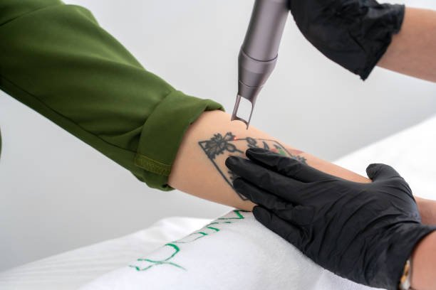 laser tattoo removal in riyadh