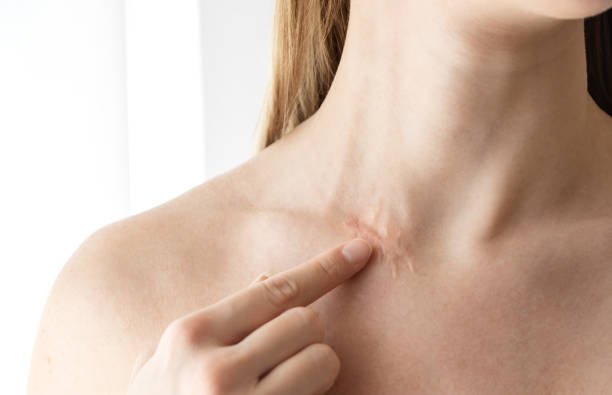 Laser scar removal in Riyadh