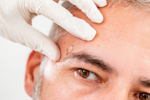 Mole Removal in Riyadh