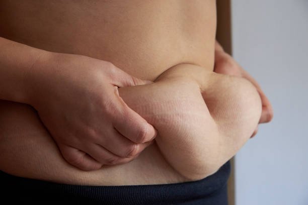 Tummy tuck in Riyadh