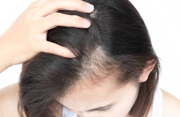 PRP Hair Treatment in Riyadh