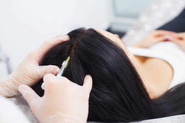 PRP Hair Treatment in Riyadh