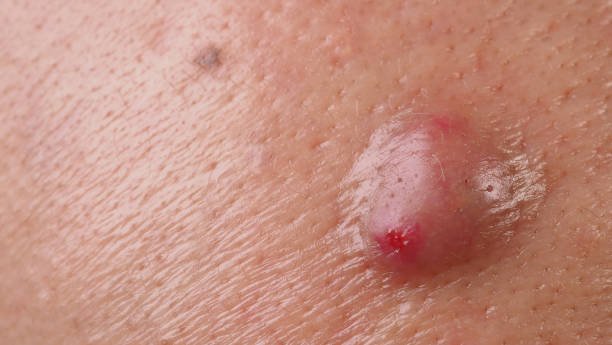 Sebaceous Cyst Removal Cost In Riyadh