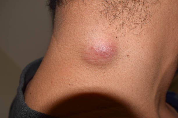 Sebaceous Cyst Removal Cost In Riyadh
