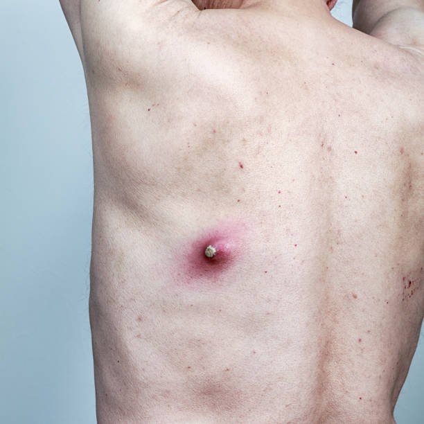 Sebaceous Cyst Removal Cost In Riyadh