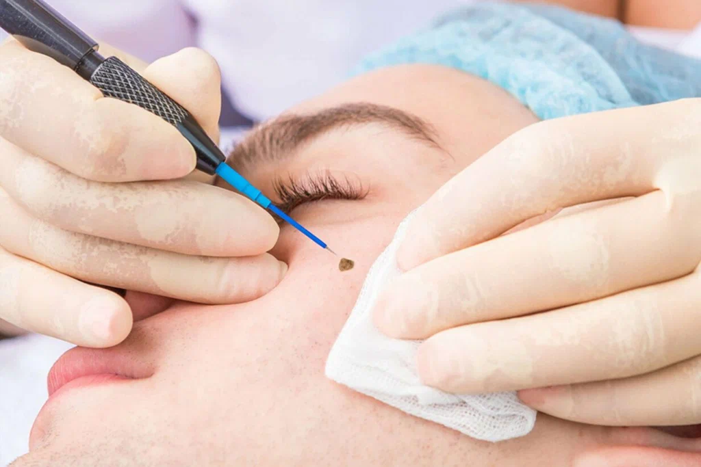 Warts Removal in Riyadh
