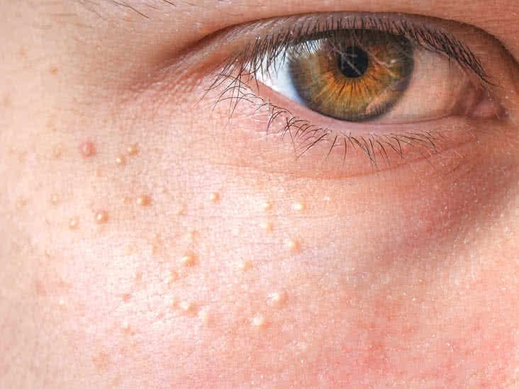Milia Treatment in Abu Dhabi