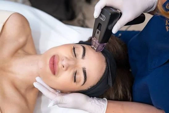 What Should You Know About Morpheus8 Treatment