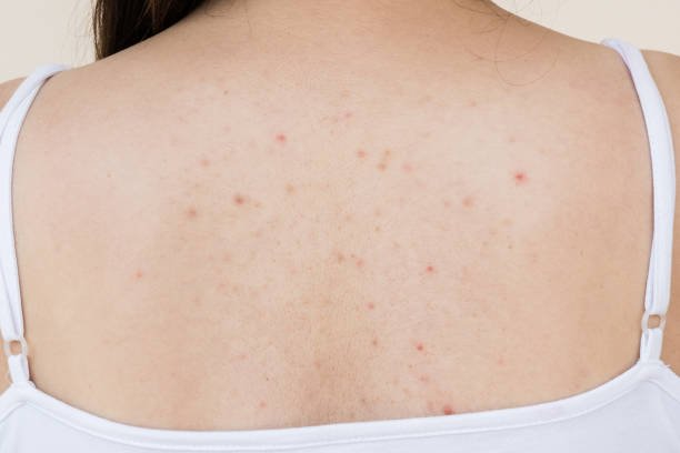 How to Treat Back Acne